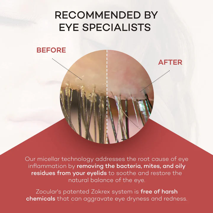 ZOCUSHIELD™ : Gel nettoyant et protecteur pour les paupières