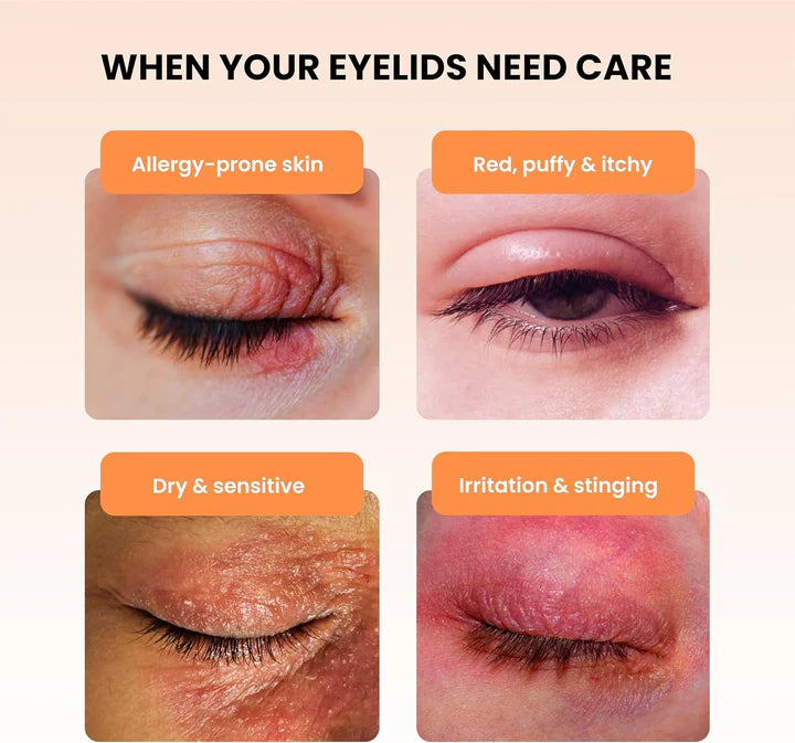 BLEPHADERM® : Crème apaisante pour paupières et contour des yeux